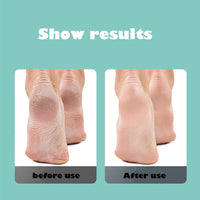 REMOVEDOR DE CALLOS ELÉCTRICO PARA PIES: FeetGlow™